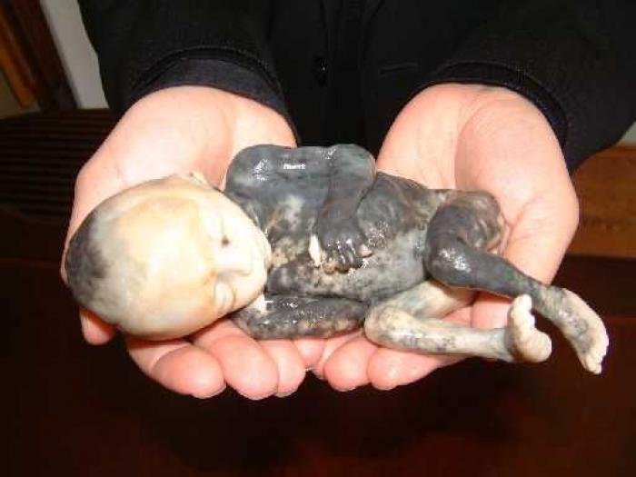 A baby killed by saline-injection abortion. (Priests for Life) 